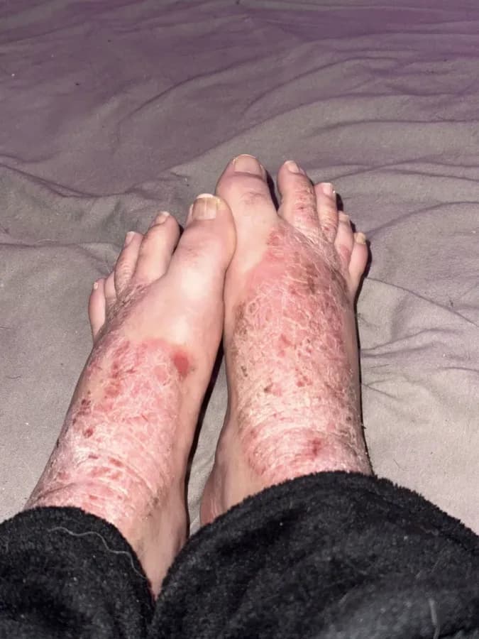 Psoriasis